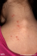 pediculosis capitis