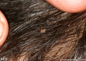 pediculosis capitis