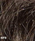 pediculosis capitis