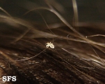 pediculosis capitis
