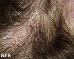 pediculosis capitis