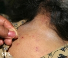 pediculosis capitis