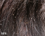 pediculosis capitis