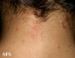 pediculosis capitis