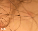 pediculosis capitis