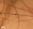pediculosis capitis