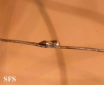 pediculosis capitis