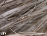 pediculosis capitis