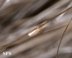 pediculosis capitis