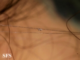pediculosis capitis
