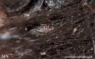 pediculosis capitis