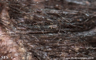 pediculosis capitis