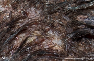 pediculosis capitis
