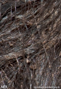 pediculosis capitis