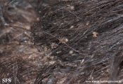 pediculosis capitis