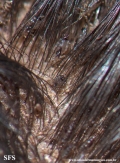 pediculosis capitis