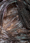 pediculosis capitis