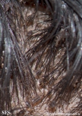 pediculosis capitis