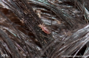 pediculosis capitis