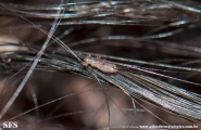 pediculosis capitis