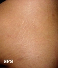 striae atrophicae