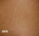 striae atrophicae