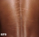 striae atrophicae