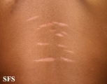 striae atrophicae