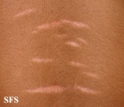 striae atrophicae