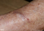 subcutaneous emphysema