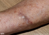 subcutaneous emphysema
