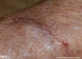 subcutaneous emphysema