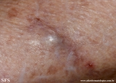 subcutaneous emphysema
