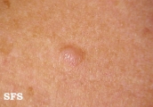 neurofibroma