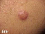 neurofibroma