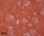 pityriasis versicolor