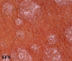 pityriasis versicolor