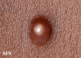 plexiform fibrous histiocytoma