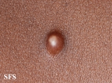 plexiform fibrous histiocytoma