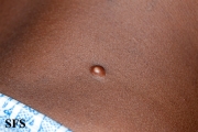 plexiform fibrous histiocytoma