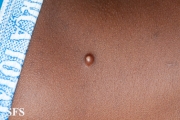 plexiform fibrous histiocytoma