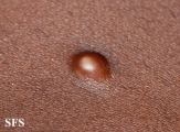 plexiform fibrous histiocytoma