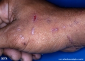 lichen planus
