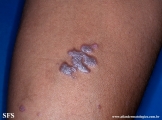 lichen planus