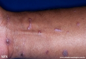 lichen planus
