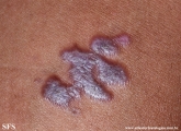 lichen planus