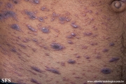 lichen planus