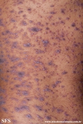 lichen planus