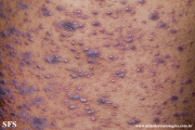 lichen planus