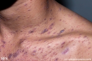 lichen planus
